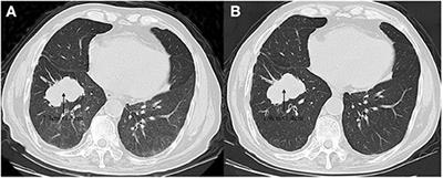 A Novel Oncogenic Driver in a Lung Adenocarcinoma Patient Harboring an EGFR-KDD and Response to Afatinib